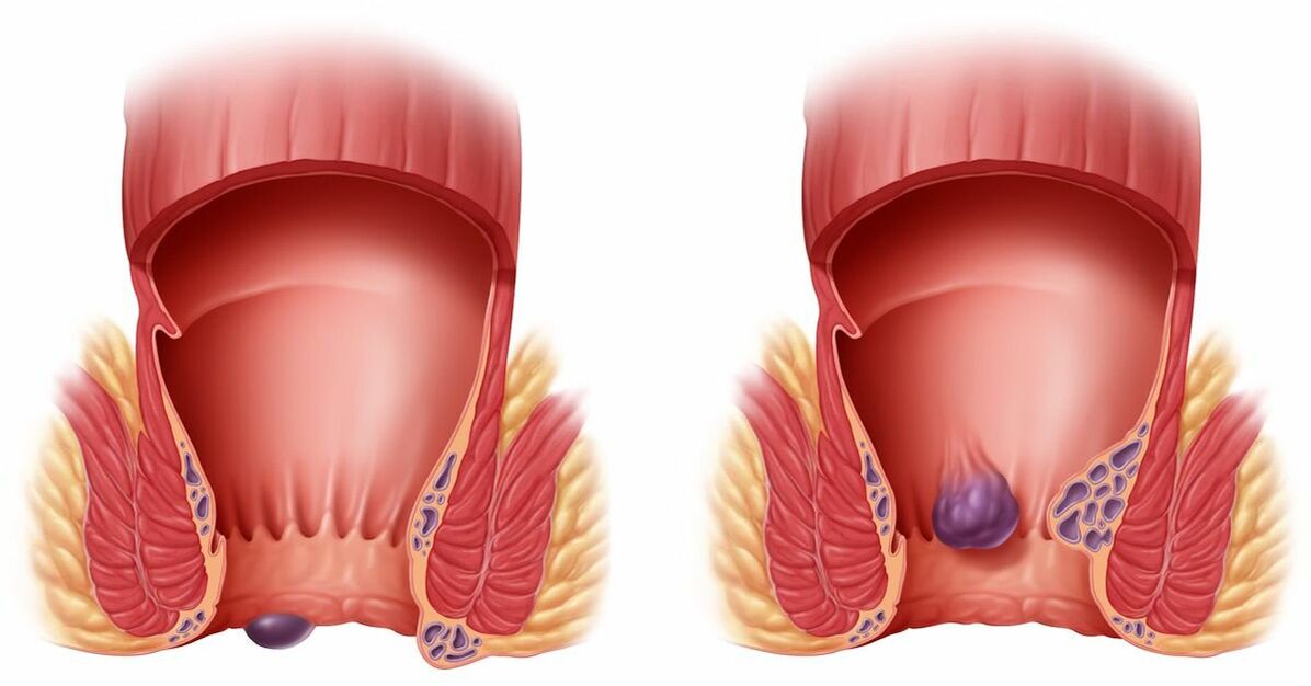 Gelarex axuda con hemorroides internas e externas